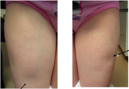 insulina distrofia diabetes