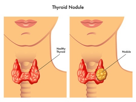Nodulo Tireoide