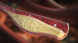 colesterol aterosclerose endocrinologista