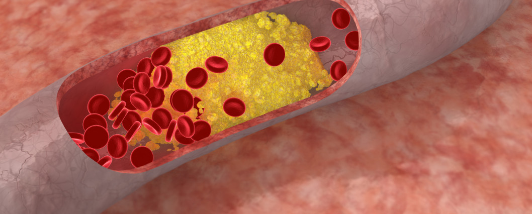 colesterol infarto tratamento endocrinologista