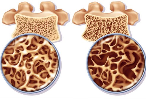 diagnostico osteoporose endocrinologista
