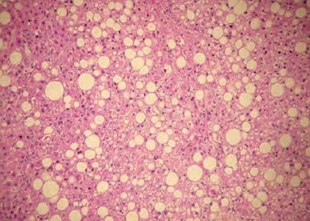 endocrinologista esteatose hepatica biopsia