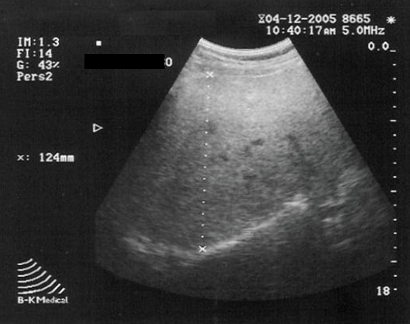 endocrinologista esteatose hepatica usg