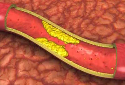 metformina tratamento diabetes colesterol