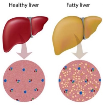 metformina tratamento diabetes esteatose hepática