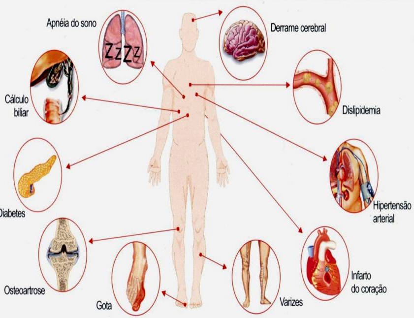 obesidade complicações diabetes