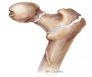 tratamento osteoporose fratura endocrinologista